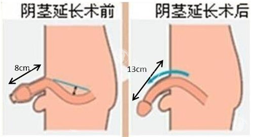 阴茎增长手术前后对比动画图