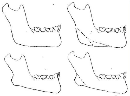 找刘正茂做轮廓手术体验：术前 3D 模拟设计，术后下颌线清晰，改善期仅 21 天！