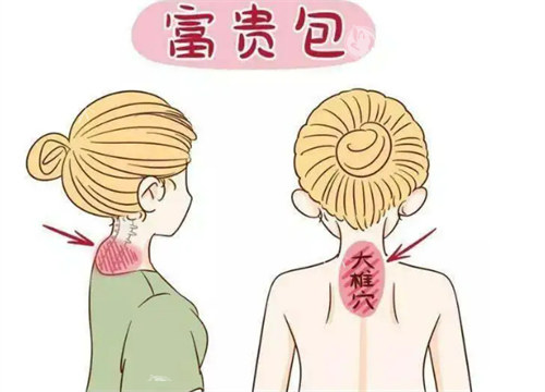 深圳曹孟君治疗富贵包好吗?可靠吗?富贵包价格1.98w起,整友满意度高