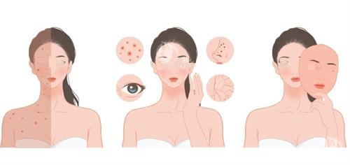 光子嫩肤治疗前后对比图