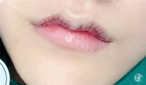 唇部整形怎么选？‘厚黑唇’改造术例分享，术后自然妈生感秘诀！