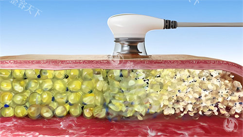 超声波溶脂过程演示图