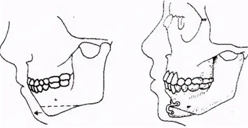 全下颌骨切除风险大吗？圣嘉新医院技术解析，术后修复注意事项！
