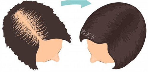 绍兴金柯桥植发医院：资质正规技术可靠，植发结果好成活率高，放心选