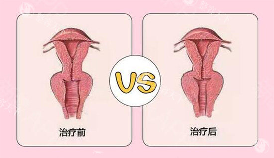 阴道紧缩针前后对比