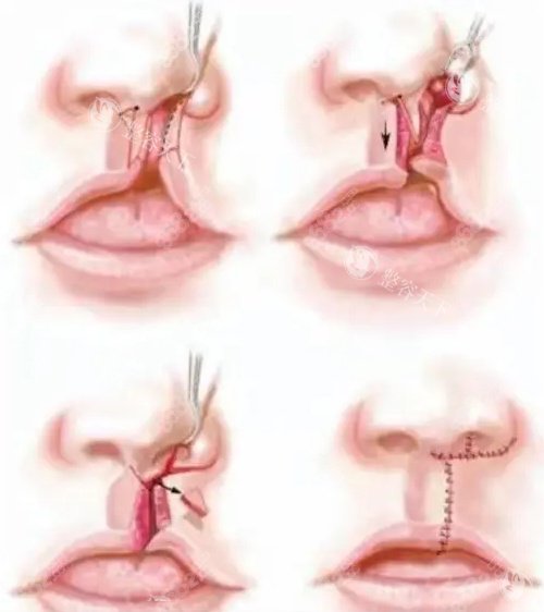 唇裂修复手术卡通图