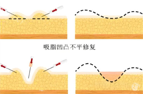 成都吸脂赵兴阳在哪个整形医院？是不是包装出来的?在武侯华生铂悦整形，擅长做吸脂手术！