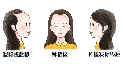 2025年韩国布莱克植发价格全公开：FUE无痕技术种植26000单位费用明细及术后结果跟踪！