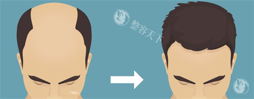 种发际线前后对比