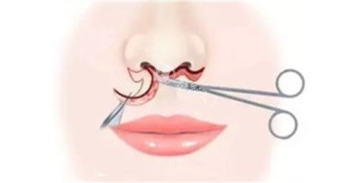 深圳福雅胡俊杰人中缩短手术全攻略：内切免拆线技术、术后零疤痕结果及8800元性价比分析！