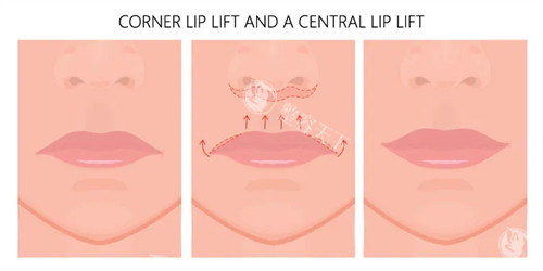 人中缩短手术动画图示