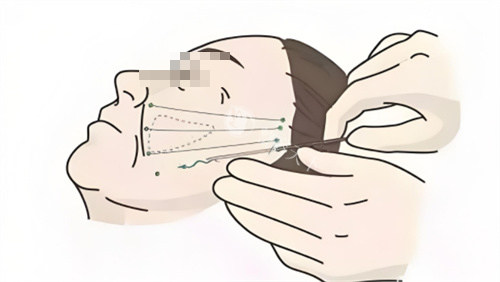 童颜支架面部提升全过程详解：从埋线植入到胶原再生，揭秘小创口提拉技术如何实现年轻化！