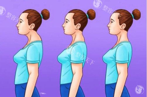 富贵包整形前后对比图