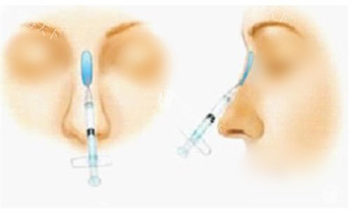 合肥隆鼻医生前三推荐：朱德刚、孙洋、徐鹏三位医生都是鼻整形口碑与技术双在线的医生！