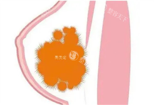 齐云香vs余东文取异物技术对比：腔内异物取出成功概率、创伤程度及复杂实例处理能力分析！