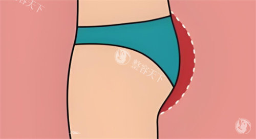 整友推荐珠海臀部整形医院排名!热门机构名单分享,技术好价格合理