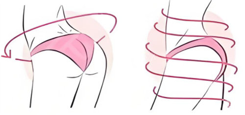 提臀手术呈现图