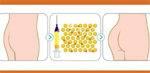 自体脂肪丰臀对比