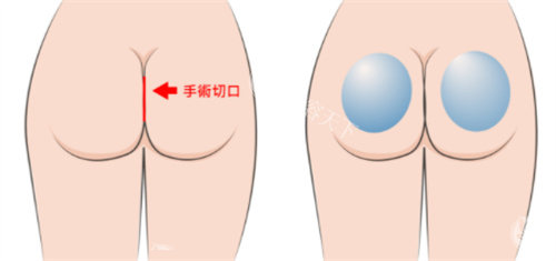 假体丰臀手术切口