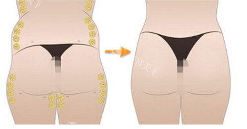 臀部脂肪填充过程展示图