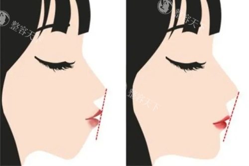 正颌手术纠结进口板还是国产板？多方面对比告诉你哪个更适合你！