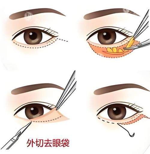 深圳朱冠峰去眼袋靠谱吗？靠谱！朱医生去眼袋技术成熟，创口小+修复期短，术后眼袋看不见，求美者好评多