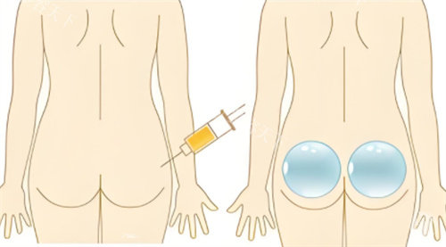 自体脂肪、假体丰臀对比