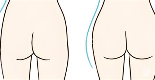 提臀手术对比图
