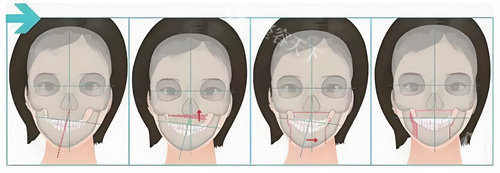 肖林正颌有失败例子吗?没有失败例子,自然派轮廓医生技术稳
