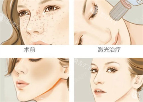 广州激光祛斑嫩肤哪家医院比较好？宝妈推荐：紫馨和曙光的温和模式不刺激，祛斑+嫩肤一步到位