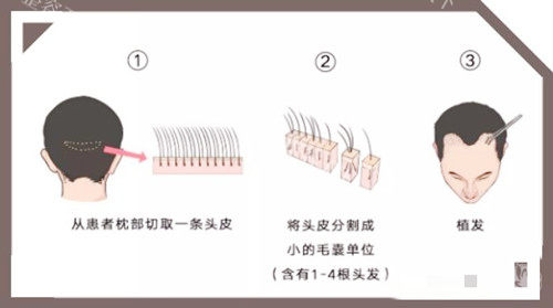 青岛南诺美德头发移植图示