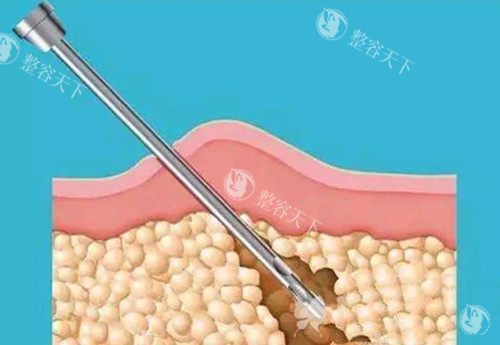 合肥抽脂一般多少钱？2025价格表：腰腹18000元起、大腿15000元起、手臂8000元起！
