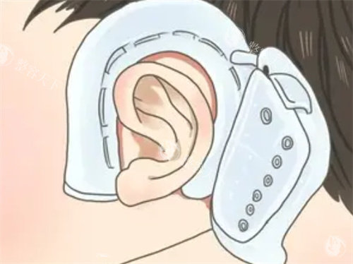 耳朵矫正器的形状