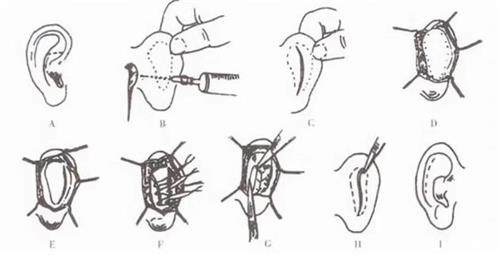 耳朵矫正手术