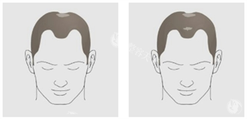 厦门新禾曙光植发发际线及头顶头发脱落素材