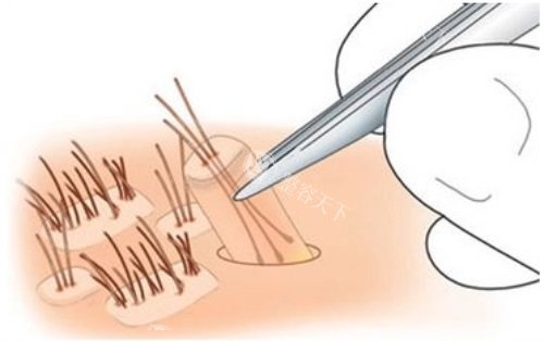 提取毛囊示意图