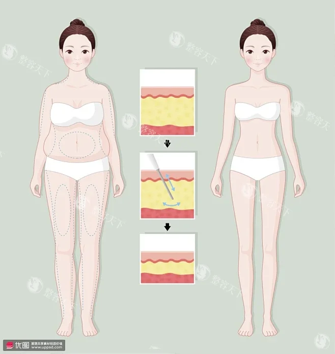 上海李鸿君医生整形怎么样，擅长做吸脂和隆胸手术经验很丰富！