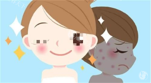 光子嫩肤成效图