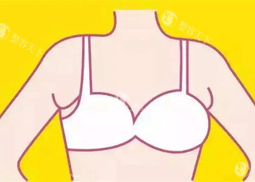 副乳位置卡通示意图 (2)