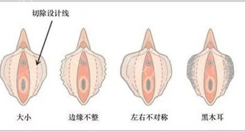 女性私密阴唇整形示意图