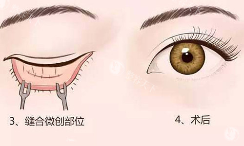 吉安割眼袋哪家医院好多少钱？吉安天姿/上喜/韩美整形祛眼袋技术及收费标准对比