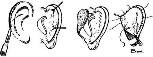 郑州大学第二附属医院正美医疗美容李钢医生简介:擅长耳再造/磨骨/眼修复_价格4w起_临床实例多!