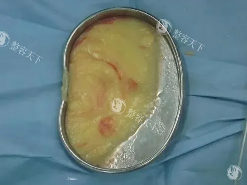 郑州大学第二附属医院正美医疗美容注射物取出价格:李会勇/李钢操作_5k-2w元_安心有确保!