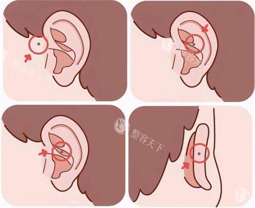 耳前瘘管手术过程