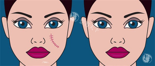 苏映军治疗疤痕超靠谱！经验充足手法精，疤痕修复结果看得见