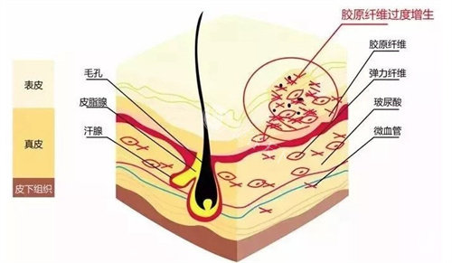 增生疤痕示意图