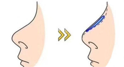 隆鼻鼻背假体前后对比图