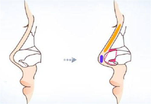 鼻尖鼻梁隆鼻手术前后对比图