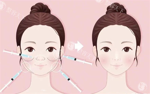 针剂注射打造幼态脸