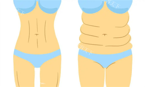 成都张红芳医生吸脂怎么样好不好，吸脂均匀改善快术后皮肤紧致超推荐！